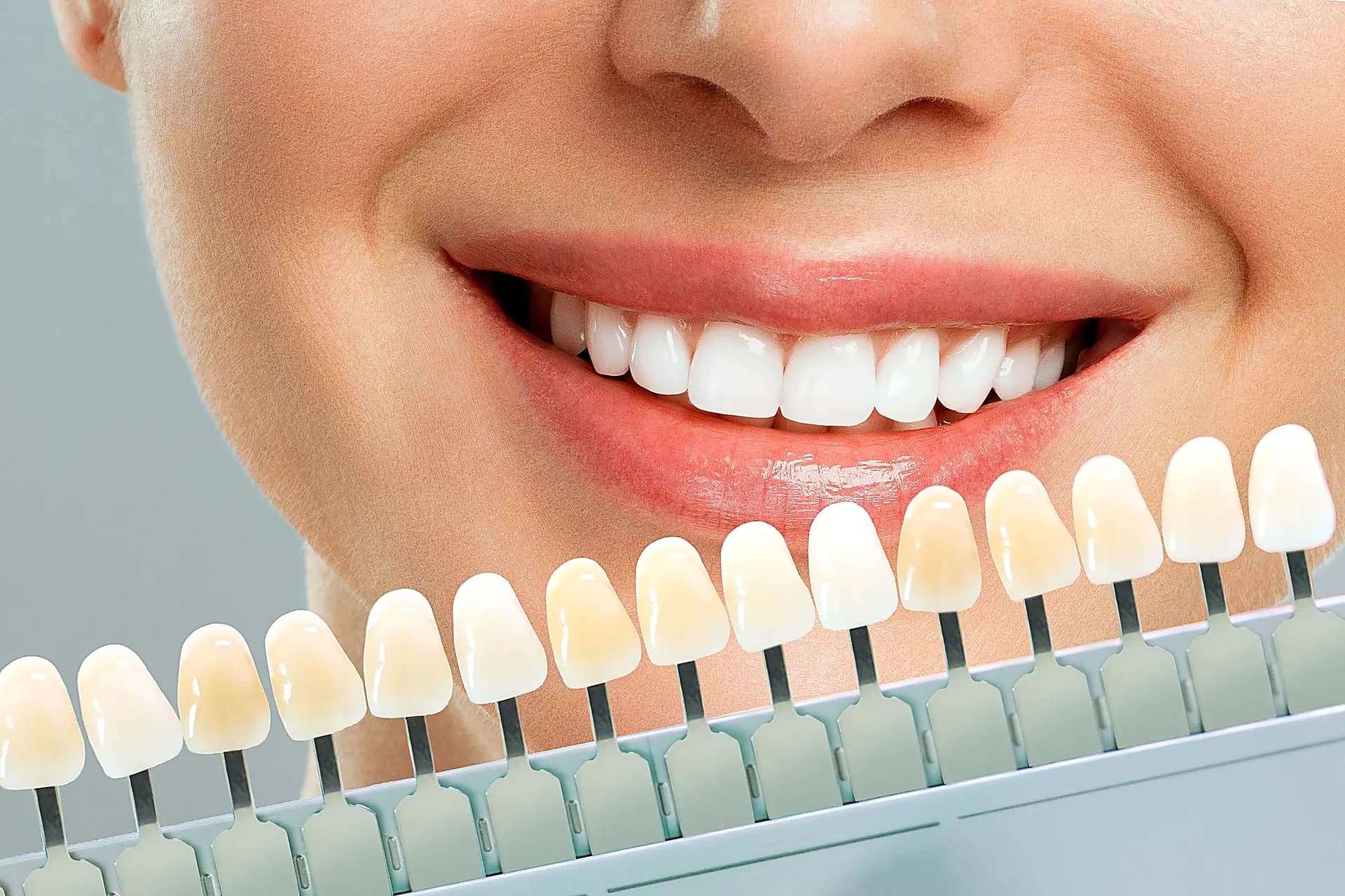 Blanqueamiento dental profesional en Dosis Dental