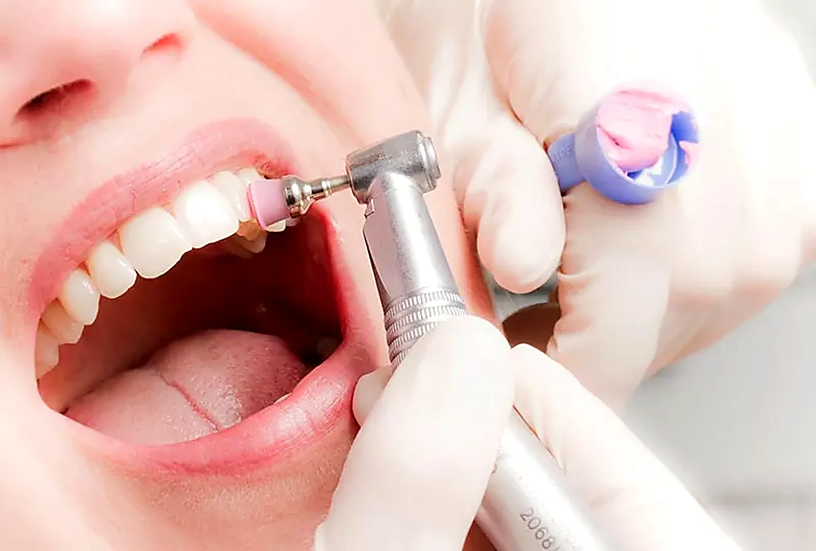 Limpieza dental profesional en Dosis Dental